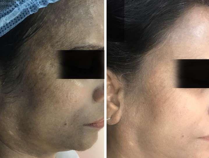 before-after