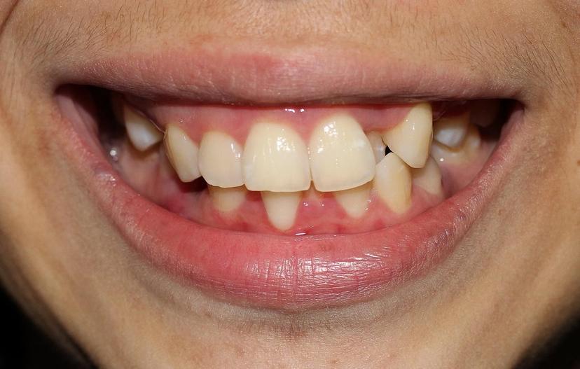 Wondering How to Fix Teeth Crowding for a Perfect Smile? Here's How!