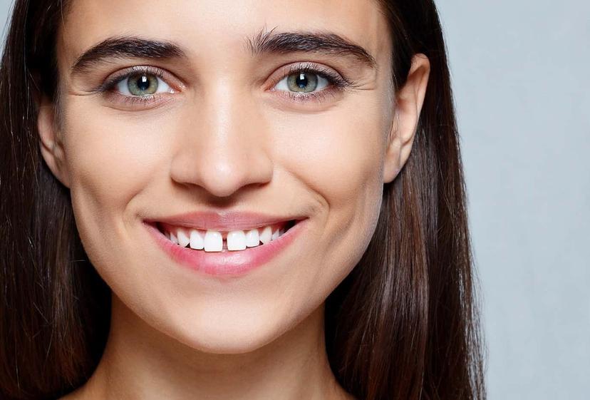 Have a Teeth Gap? Here's How You Can Fix It with Invisible Braces for Teeth Gap