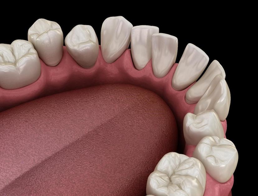 Can Teeth Become Crooked with Age?