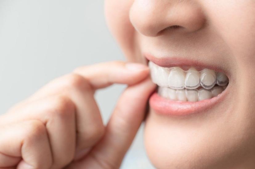 Braces for Adults: Common Signs You May Need Them