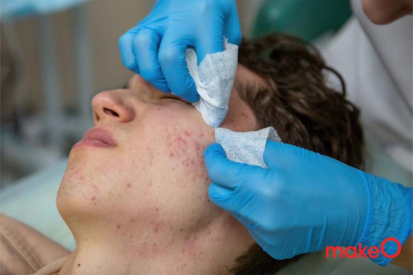 How to Make the Most of Your Acne Spot Treatments?