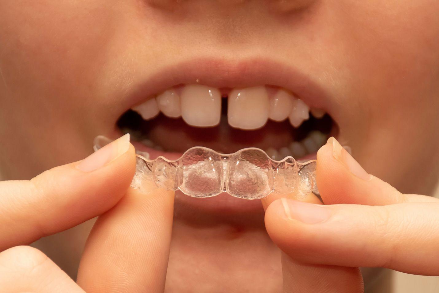 Impressions Vs Other At-Home Invisible Aligners - Impressions Smile