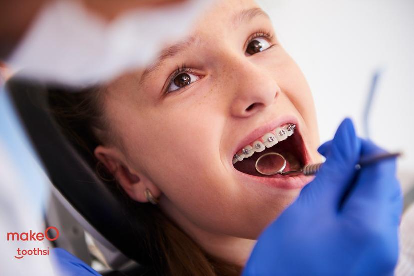 Can Braces Harm You? - A Detailed Look at Their Effects on Oral Health