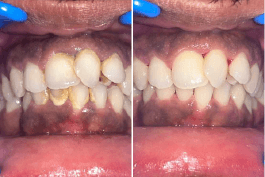 before-after