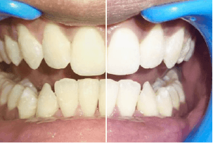 before-after