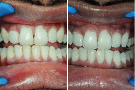 before-after