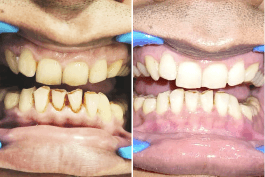 before-after