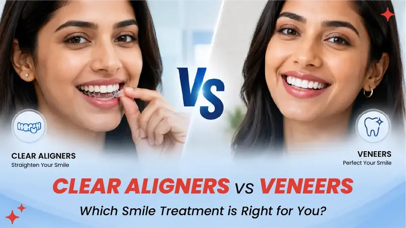 Clear Aligners or Veneers: Which One Is Right for You?