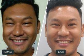 before-after
