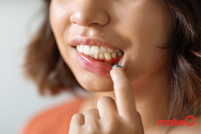 What is Gingivitis? Know Symptoms, Causes & Treatment