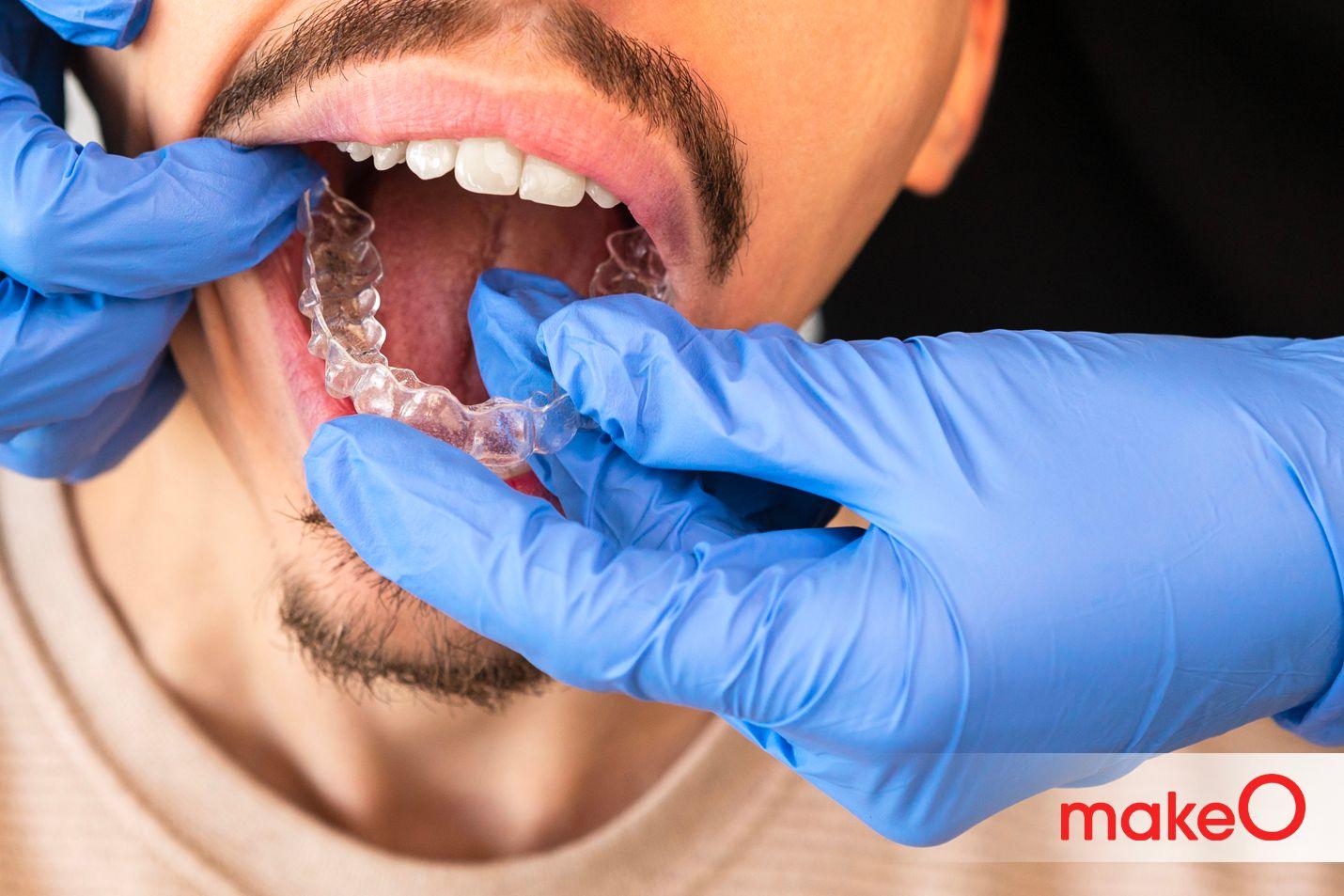 Misaligned teeth problem 