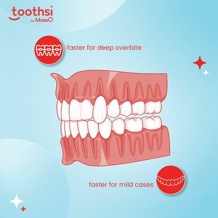 Choosing Between Aligners and Braces – Which Works Faster?