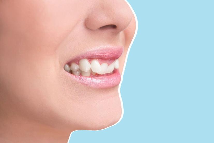 Shifting Teeth: Causes, Symptoms & Treatments