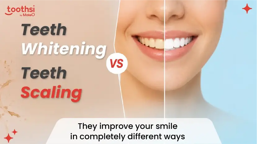 Teeth Scaling vs Teeth Whitening: Which One is Right for You?