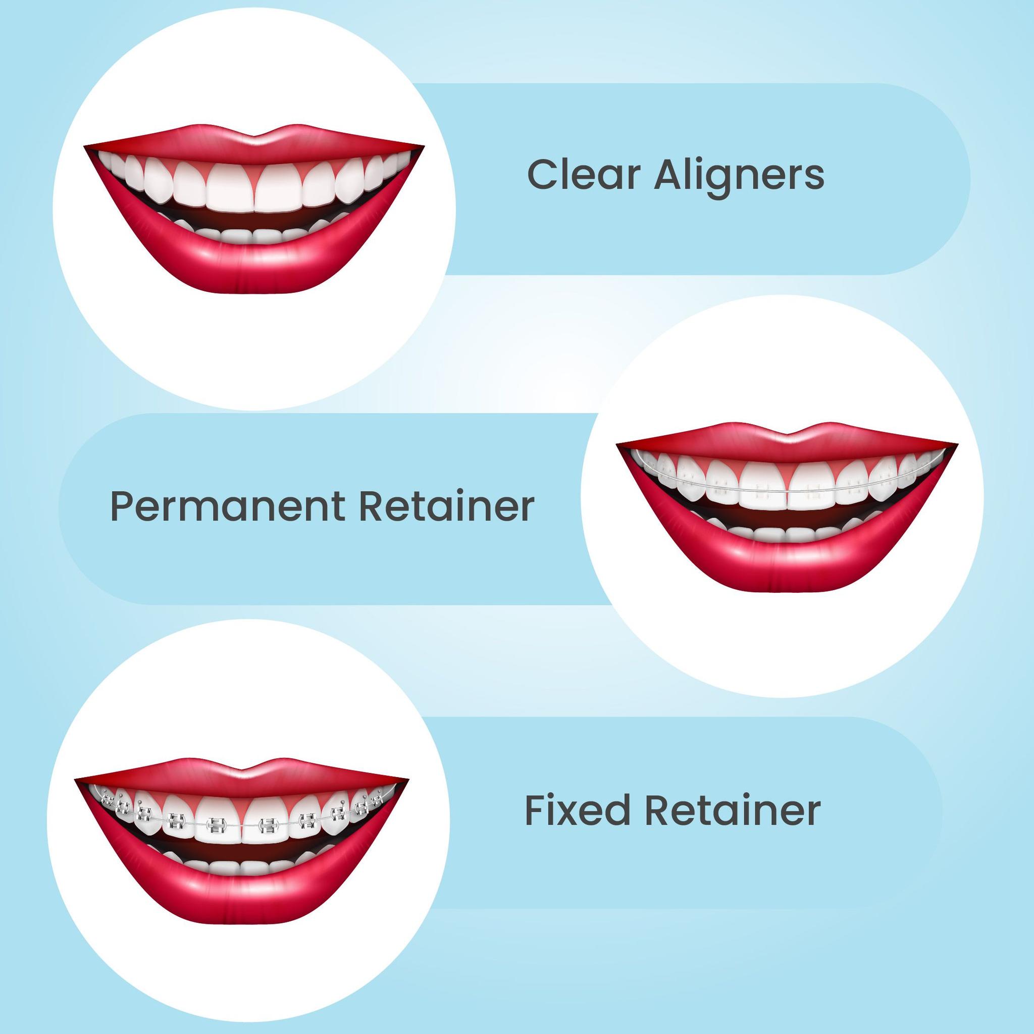 Teeth Retainer 101: Purpose, Benefits & What to Expect