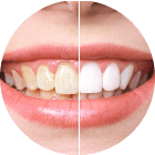 Yellowing Teeth