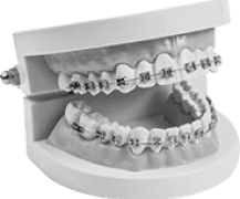common side-effects of braces you need to know about
