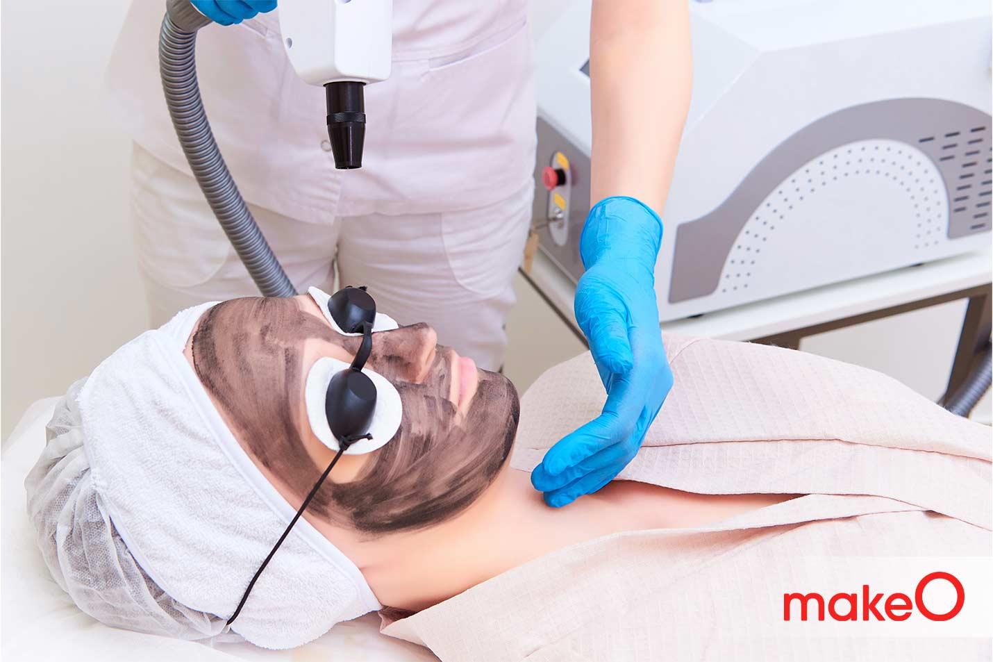 carbon peel