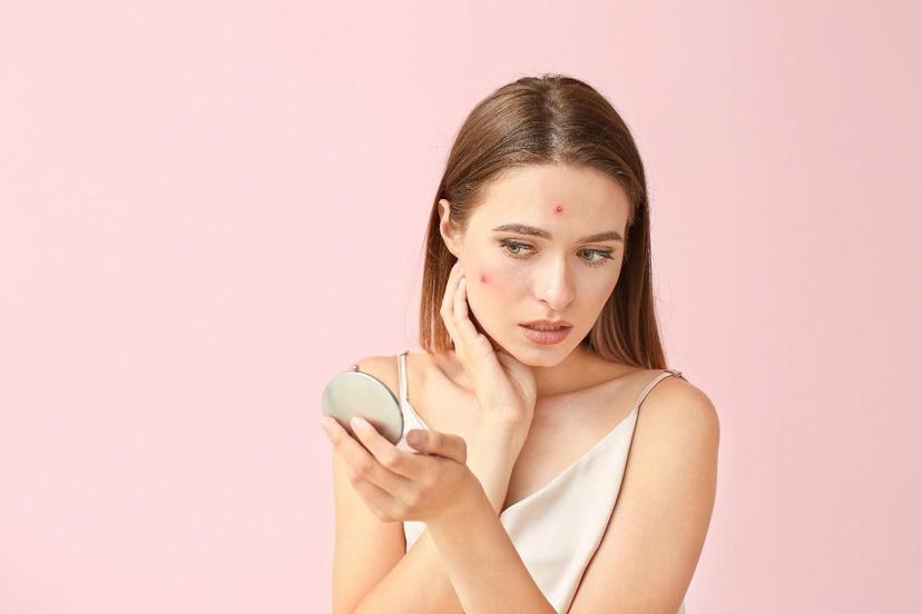 Can You Fight Acne at Home? Best Home Remedies for Pimples
