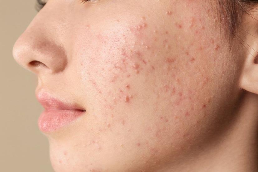 8 Tips on How to Remove Pimples