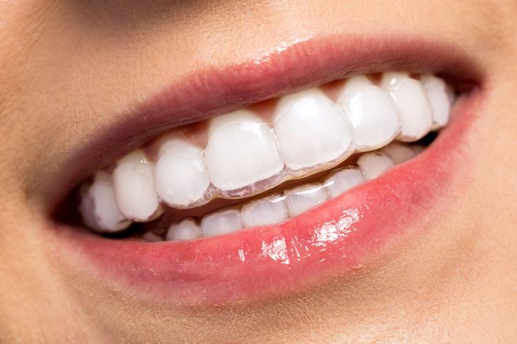 teeth whitening advantages
