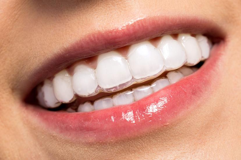 10 Proven Teeth Whitening Benefits 