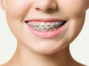 metal braces