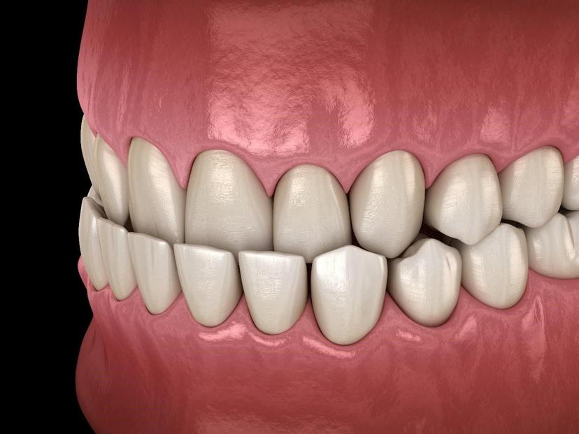 Here’s How You Can Say Goodbye To Underbite Making You Feel Underconfident, This New Year