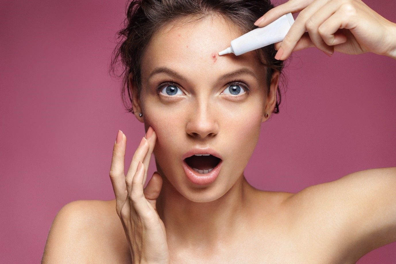 what-is-nodular-acne-factors-to-keep-in-mind-before-the-treatment