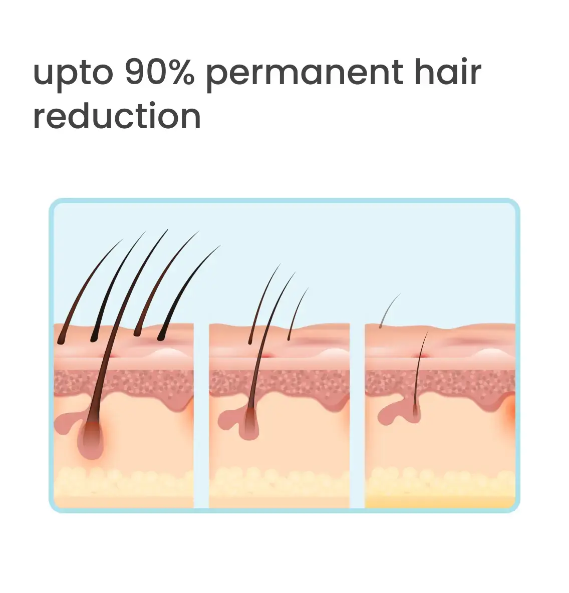 90% permanent hair removal