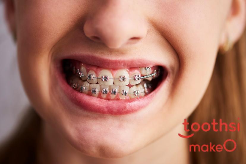 How Much Do Braces Cost in India?