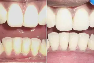 before-after