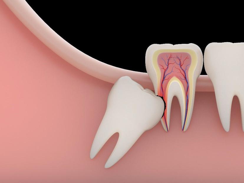 What is Tooth Erosion? Symptoms and Treatment
