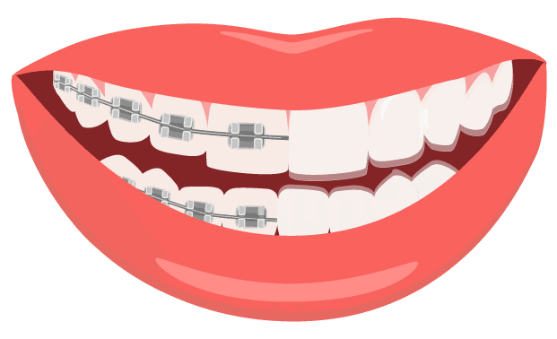 toothsi clear aligners vs braces
