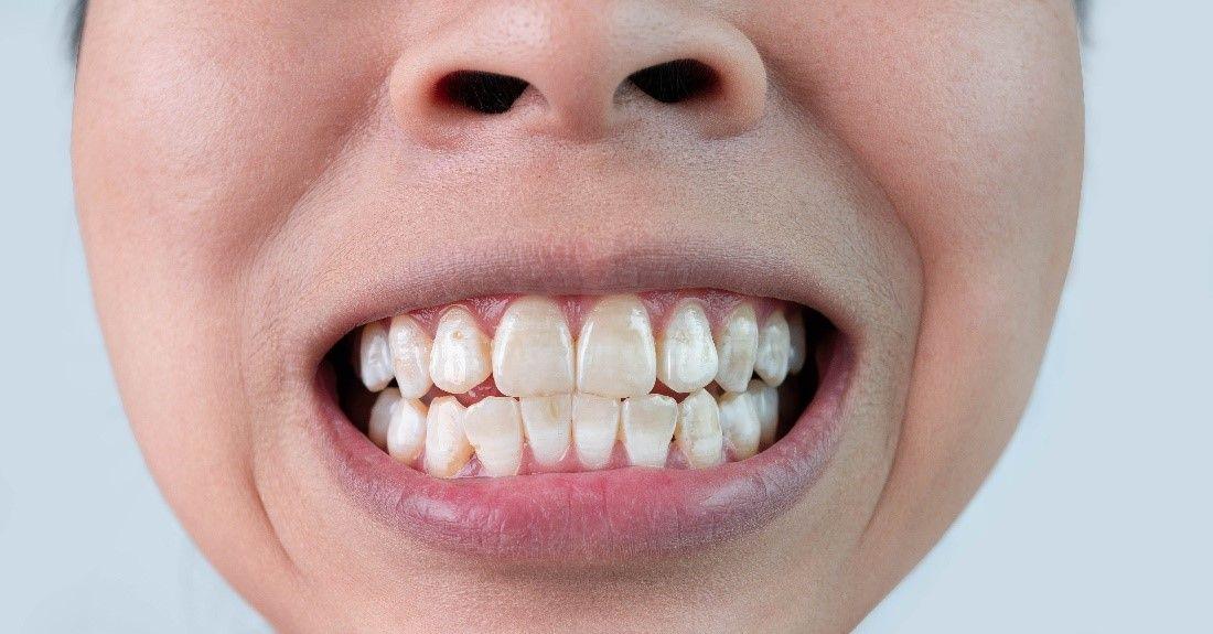 teeth whitening products