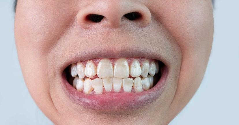 What is Teeth Grinding or Bruxism? Here’s Everything You Should Know!